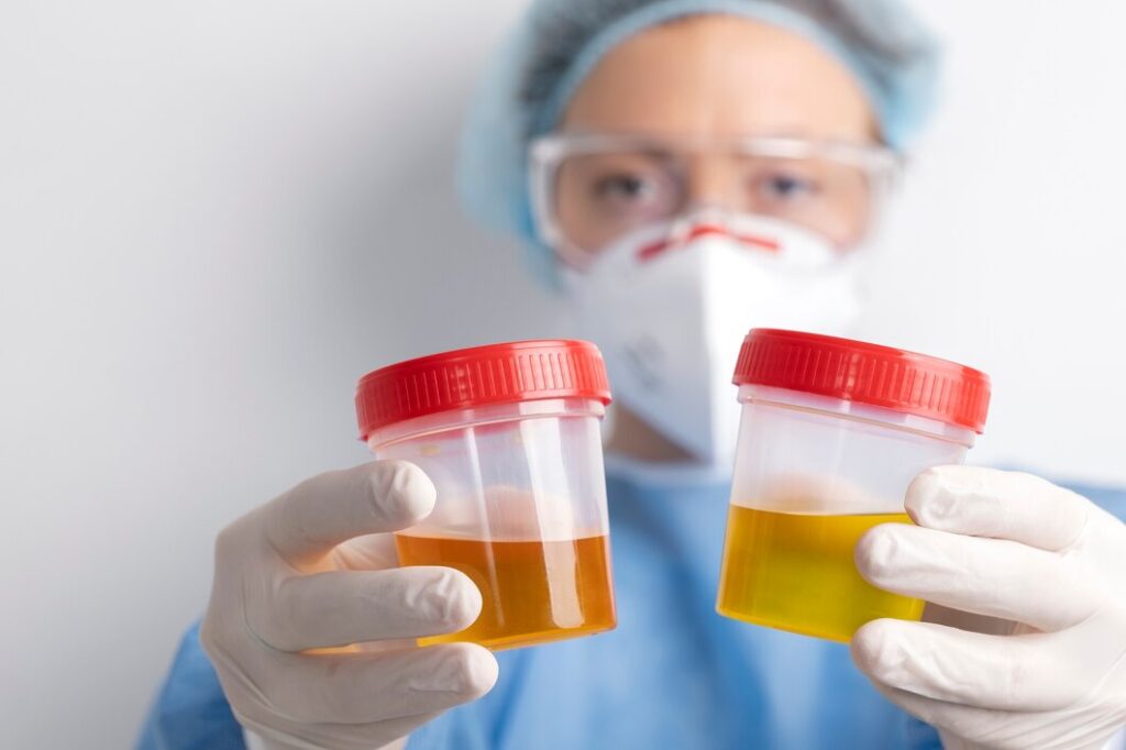 Complete Urine Examination (CUE) in hastinapuram