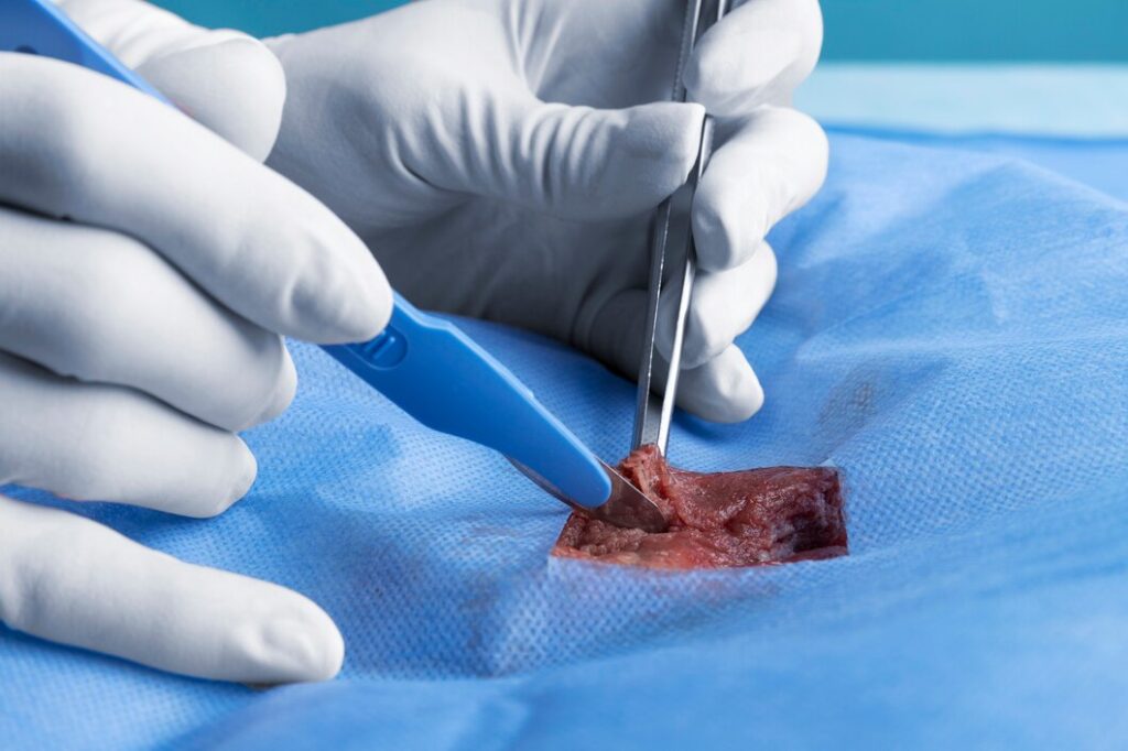 tru cut biopsy in hastinapuram